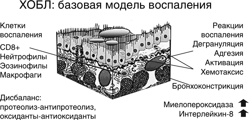 Рисунок 26 ХОБЛ модель воспаления Самым частым фоном у больных ХОБЛ - фото 33
