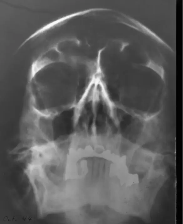 Photo 9 An xray taken of Hitlers face in Autumn 1944 stored in the US - фото 41
