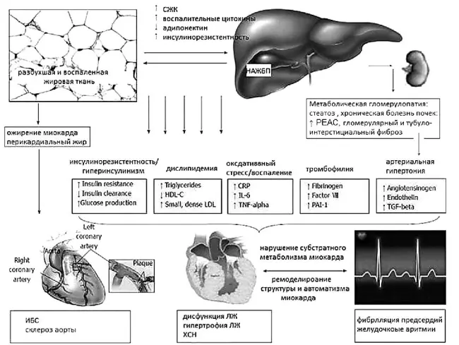 Рис 34 Мультисистемные влияния НАЖБП как компонента МСмодифицировано по - фото 37