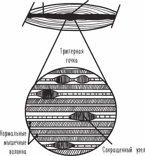 Рис 7 Триггерная точка это локальный участок уплотнения в мышечных волокнах - фото 7