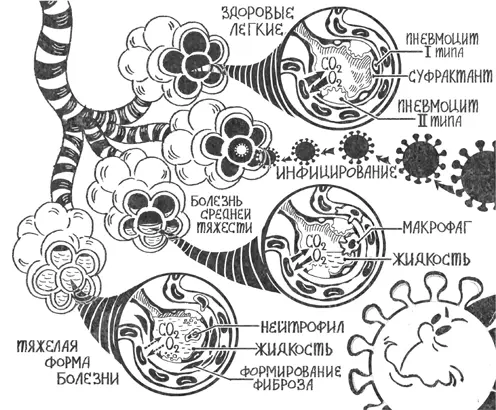 Рис 7Альвеолы здоровых легких это надутые шарики в которых происходит - фото 12