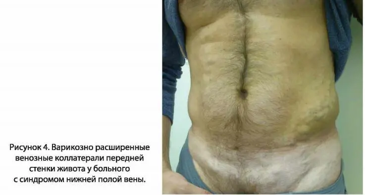 Заболевание как правило начинается с проявлений острого венозного тромбоза - фото 5