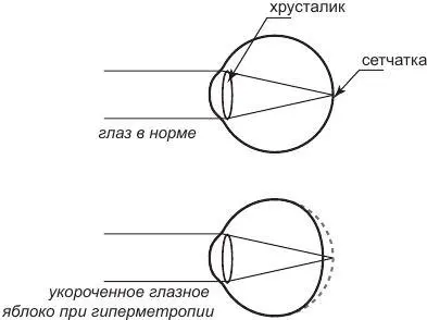 При дальнозоркости воспринимаемые глазом лучи света сходятся в фокусе позади - фото 5