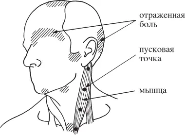 Рис 31Ключ к иллюстрациям Пусковые точки и области отраженной боли везде - фото 3