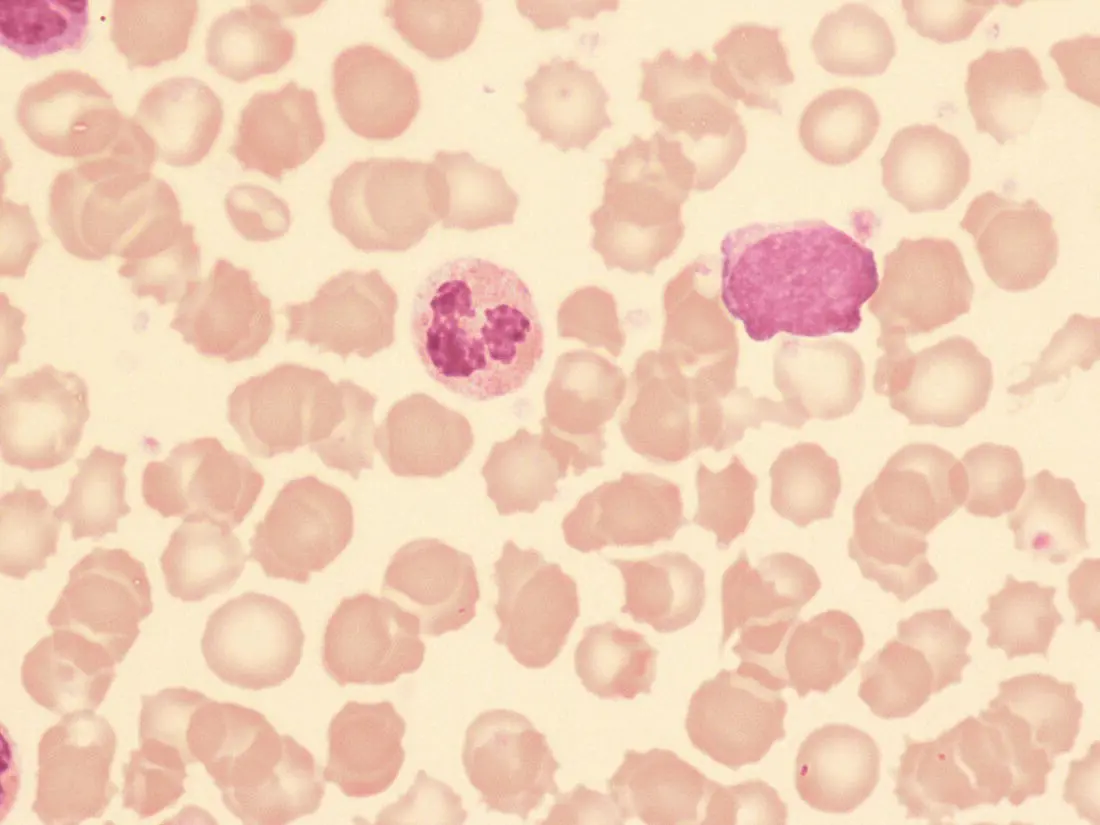 Fig 114 Blood film of a healthy preterm neonate born at 25 weeks gestation - фото 15