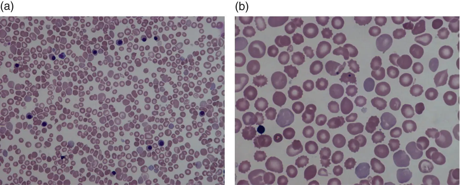 Fig 110 Blood film showing features of hyposplenism resulting from - фото 11
