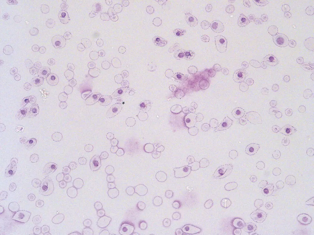 Fig 15 First trimester 8 weeks fetal blood film showing the large size of - фото 6