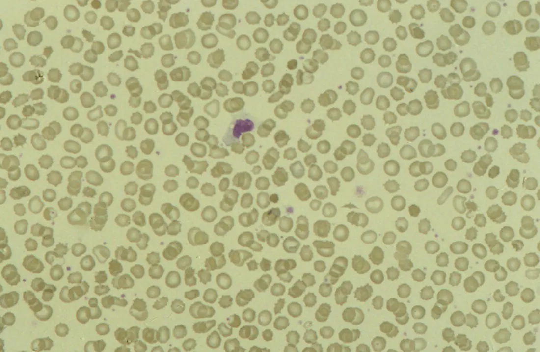 Fig 116 Blood film of a preterm neonate with early clinical signs of - фото 17