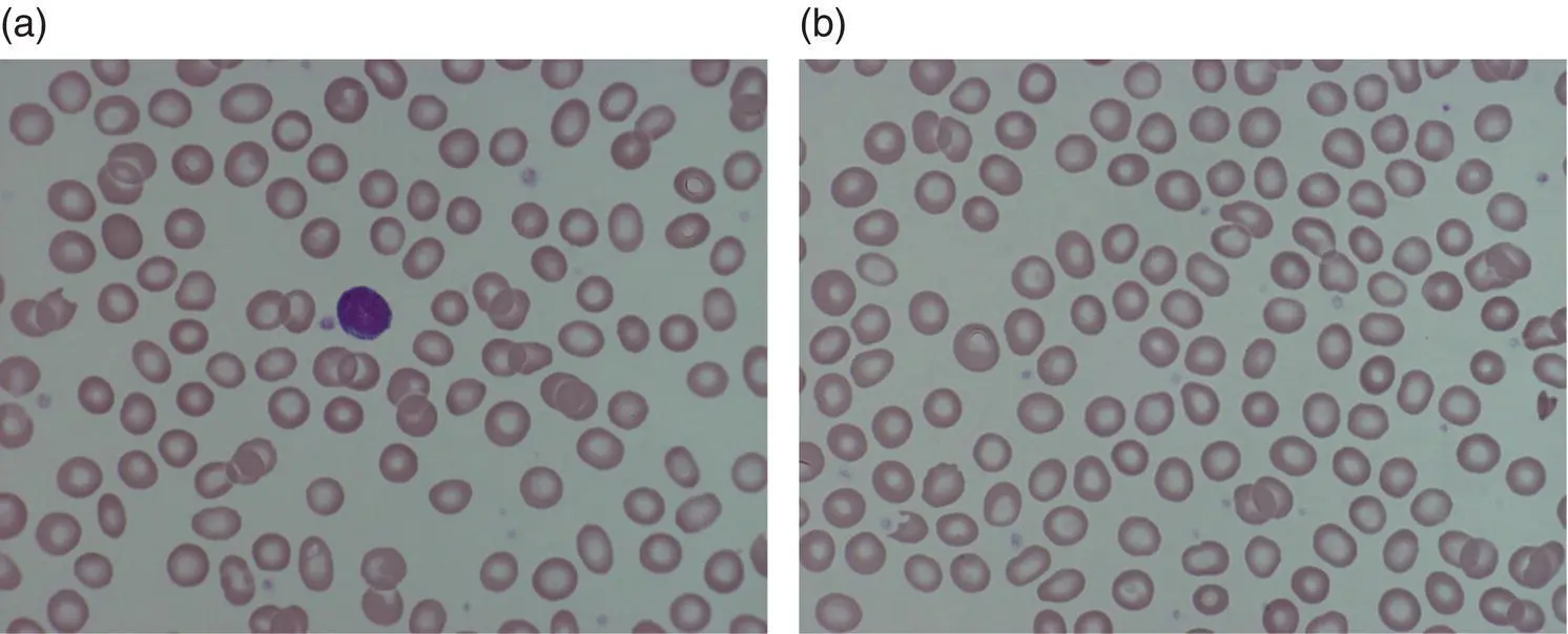Fig 112 Impact of postnatal age on red cell morphology blood films from a - фото 13