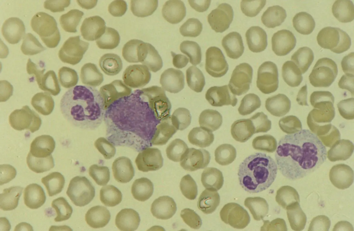 Fig 115 Blood film of a well preterm neonate showing a myelocyte and three - фото 16