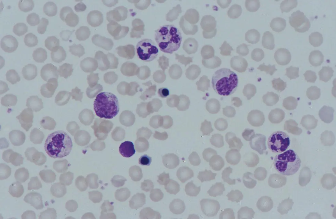 Fig 111 Blood film from a preterm neonate born at 25 weeks gestation on - фото 12