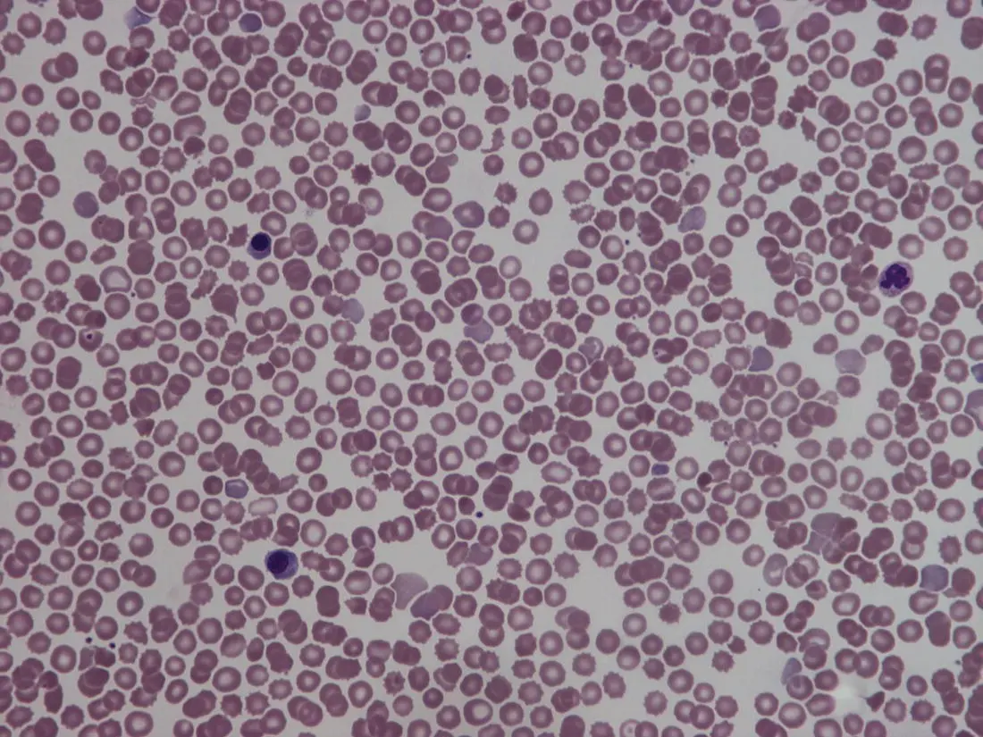Fig 19 Blood film of a normal preterm baby born at 28 weeks gestation - фото 10