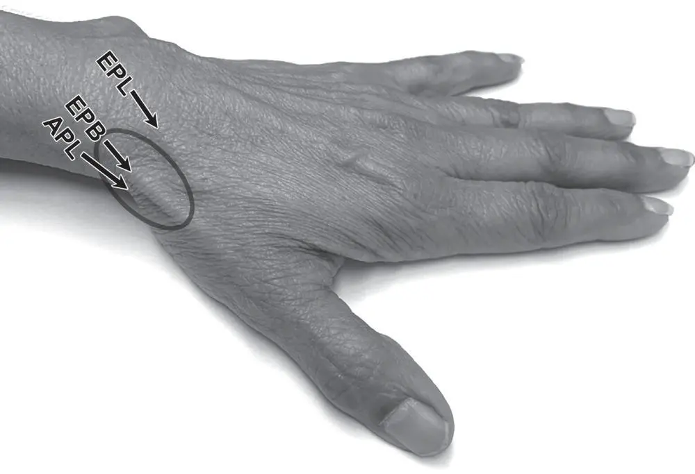 Figure 24 The site of de Quervains syndrome is encircled APL abductor - фото 5