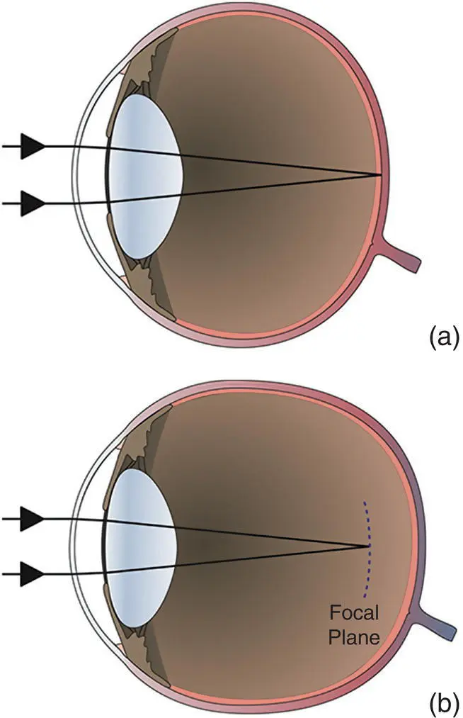 Figure 211 The effect of vitreous elongation on ocular refraction a A - фото 73