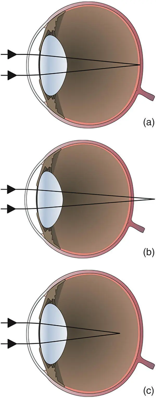 Figure 212 a In emmetropia parallel light rays are focused on the retina - фото 74