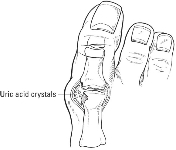 John Wiley Sons Inc FIGURE 41Crystal deposits in a gouty joint The - фото 63