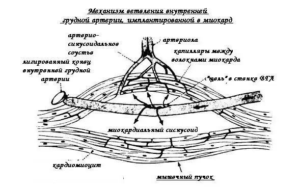 Рис 3 Схематичное изображение имплантированной внутренней грудной артерии в - фото 3