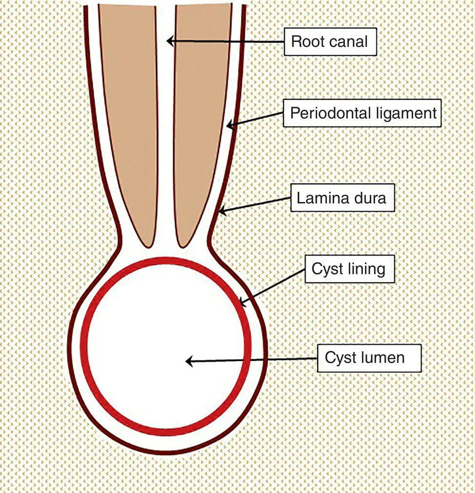 Figure 22 Diagrammatic representation of a radicular cyst The cyst develops - фото 5