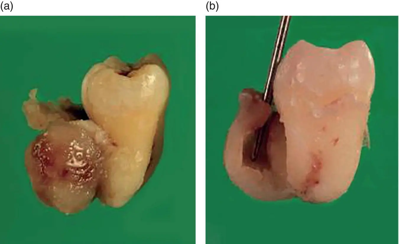 Figure 46 Gross specimen of a paradental cyst on the buccal aspect of a - фото 30
