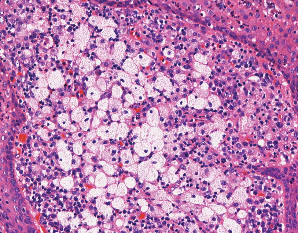 Figure 317 A focal accumulation of plump foamy histiocytes in the wall of a - фото 23
