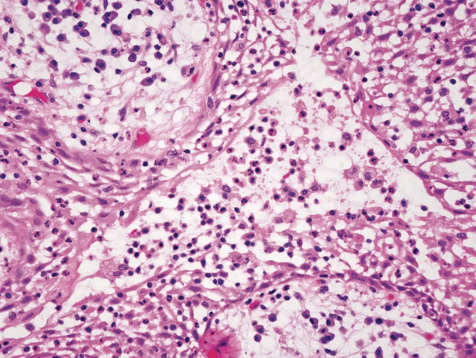 Figure 39 Degeneration of cells in the centre of a mass of proliferating - фото 15