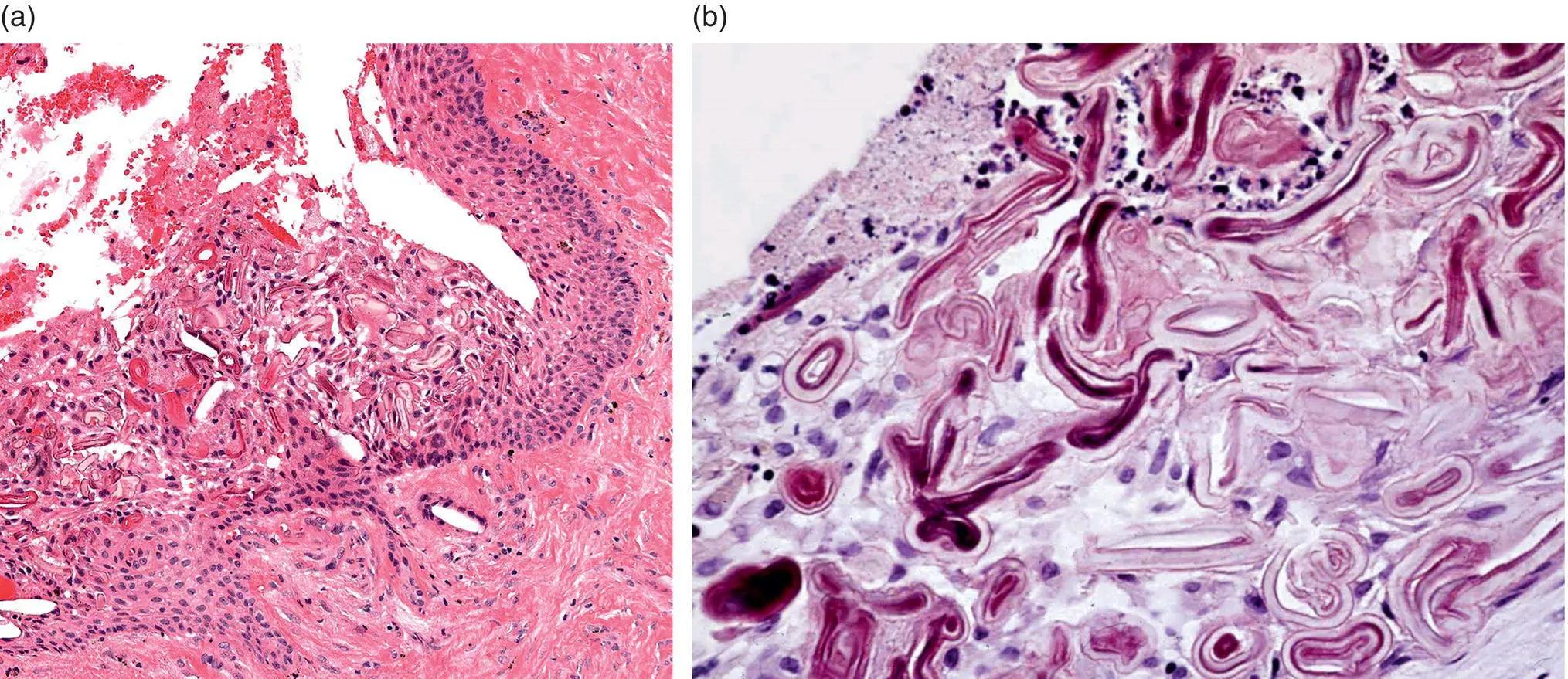 Figure 315 Hyaline bodies in the epithelial lining of a radicular cyst a - фото 21