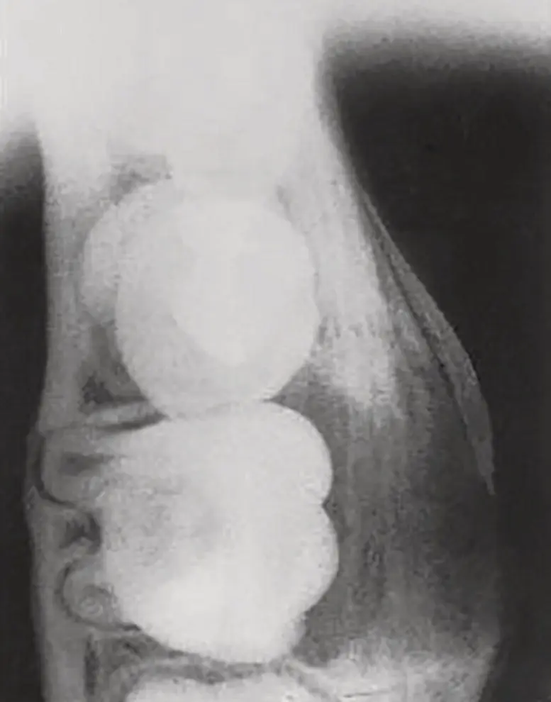 Figure 44 Occlusal view of a mandibular buccal bifurcation cyst on a - фото 28