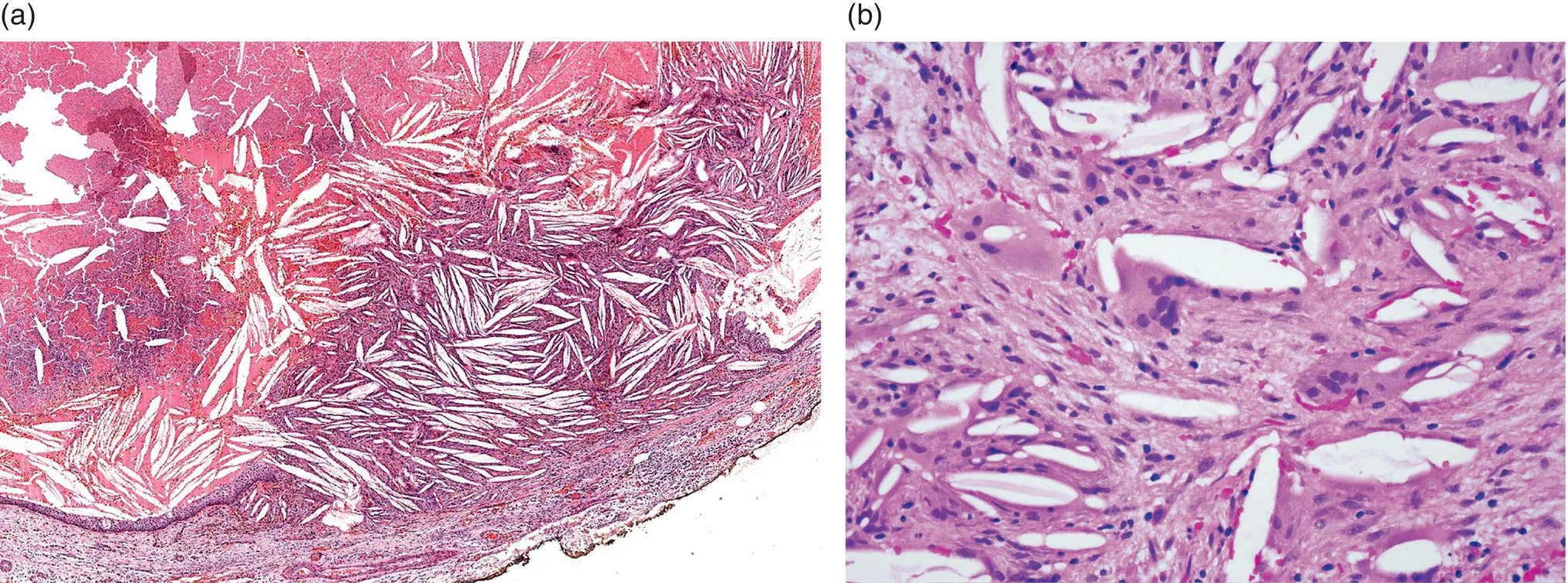 Figure 316 Cholesterol clefts in a radicular cyst a An accumulation of - фото 22