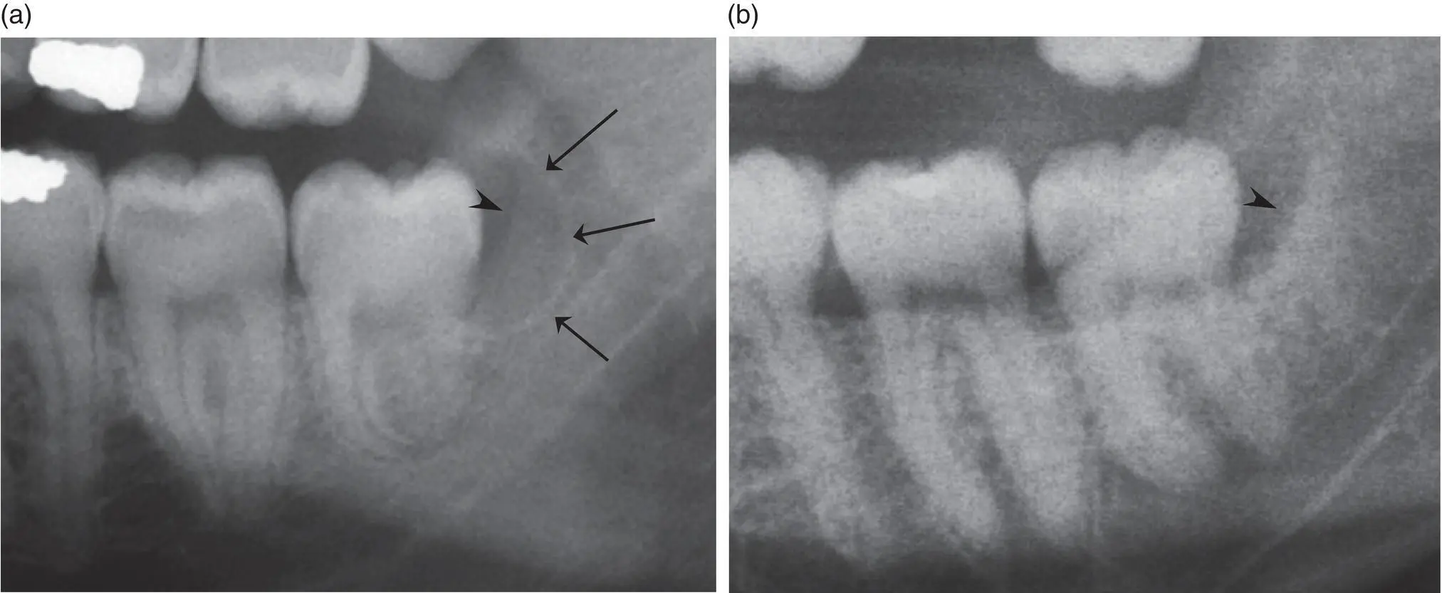 Figure 45 Differential diagnosis of the paradental cyst a The cyst is well - фото 29