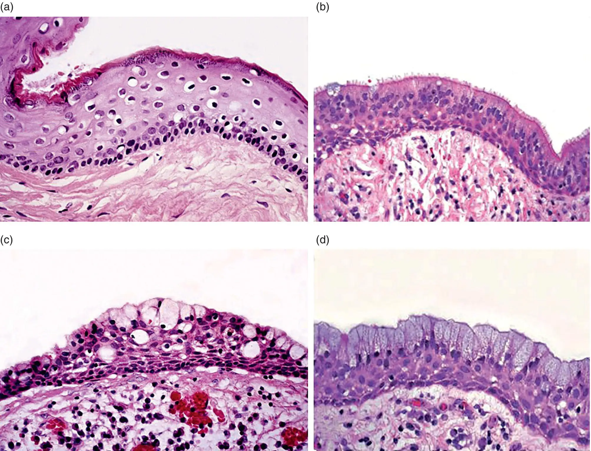 Figure 314 Cellular changes in the lining of radicular cysts a A portion of - фото 20