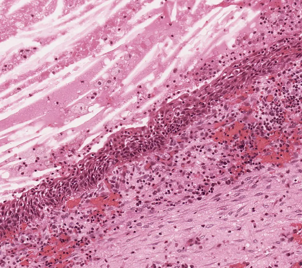 Figure 311 A longstanding radicular cyst The cyst wall has become fibrous - фото 17