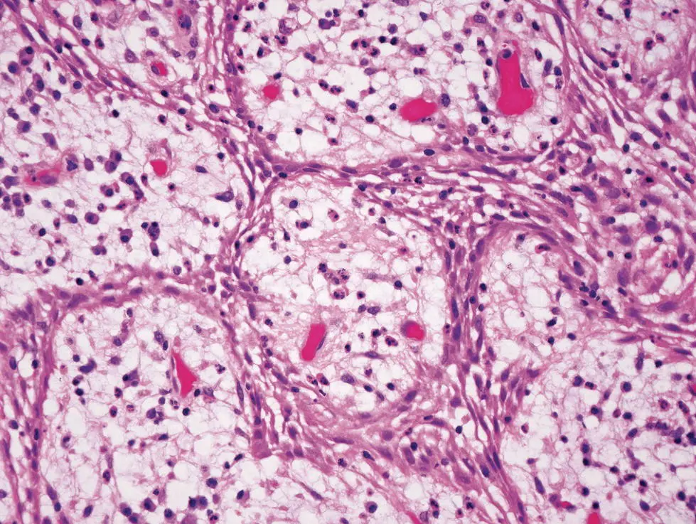 Figure 37 Arcades and rings of proliferating epithelium in a periapical - фото 13
