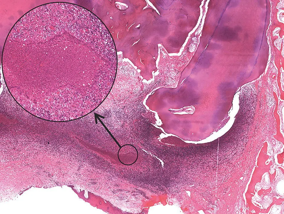 Figure 310 A periapical granuloma at the apex of a molar tooth root There is - фото 16