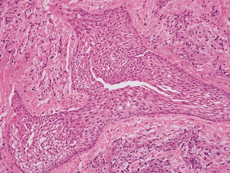 Figure 38 Sheet of epithelial cells in a periapical lesion A distinct cleft - фото 14