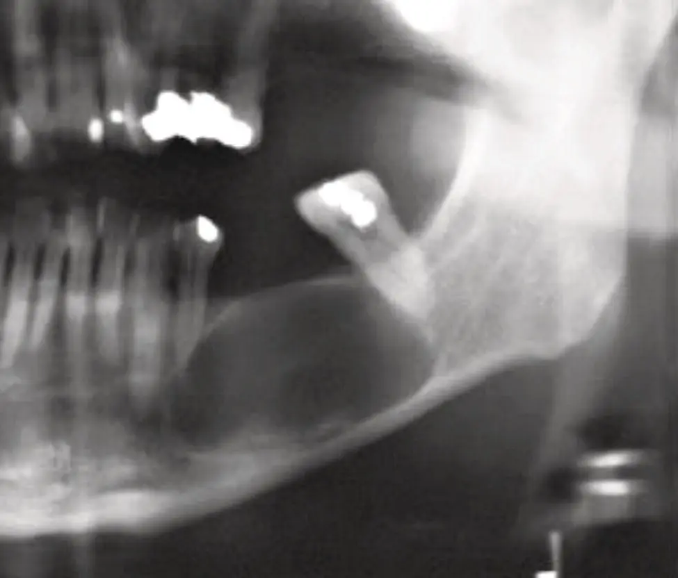 Figure 35 Radiograph of a residual cyst The lesion is at the site of a - фото 10