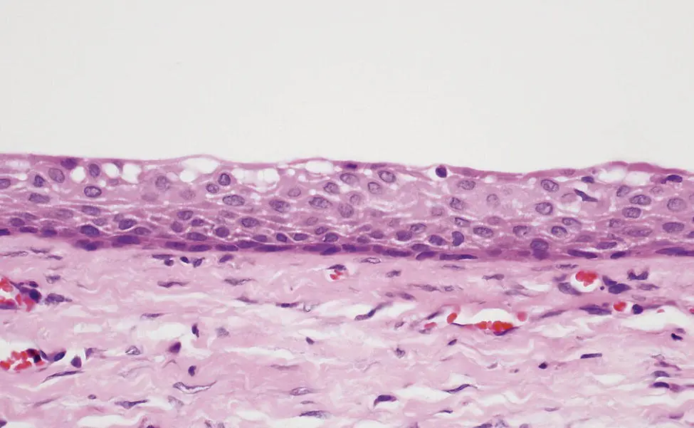 Figure 313 Quiescent epithelium lining a mature longstanding residual cyst - фото 19