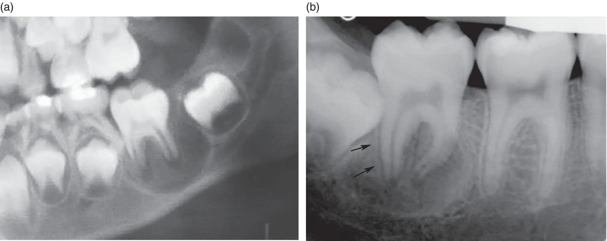 Figure 43 Mandibular buccal bifurcation cysts involving a an erupting first - фото 27