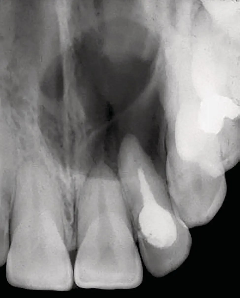 Figure 34 Radiograph of a radicular cyst The lesion is a welldefined - фото 9