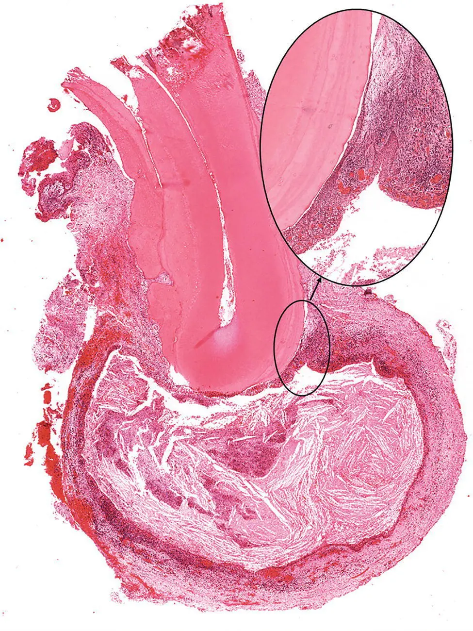 Figure 318 A lowpower view of a pocket cyst The cyst lining is attached to - фото 24