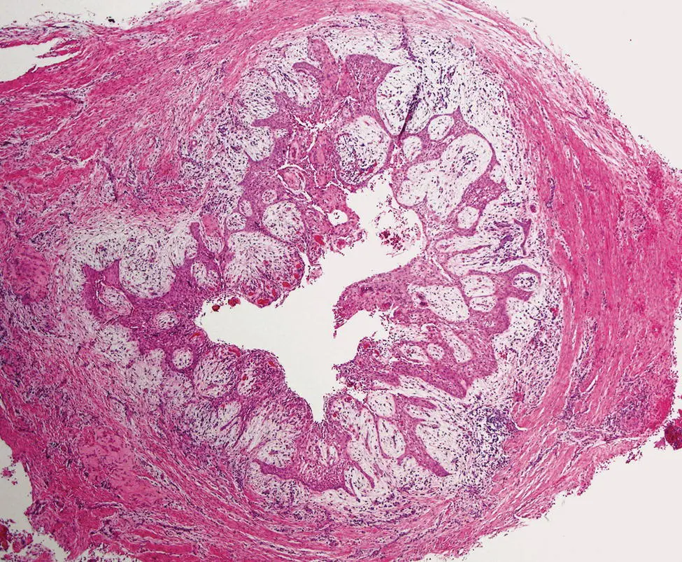 Figure 312 Radicular cyst The cyst has a thick fibrous wall The lumen is - фото 18