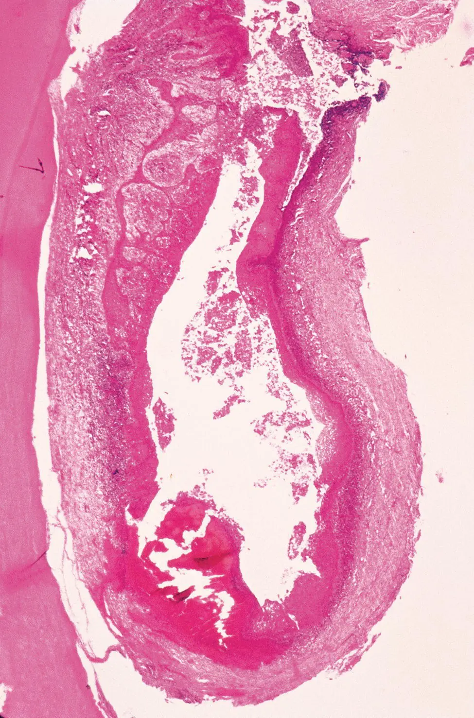 Figure 47 Paradental cyst adjacent to the root of an impacted mandibular third - фото 31