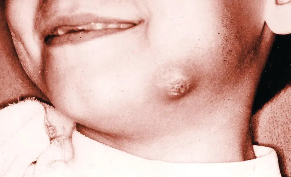Figure 41 Young boy with mandibular buccal bifurcation cyst involving a - фото 25