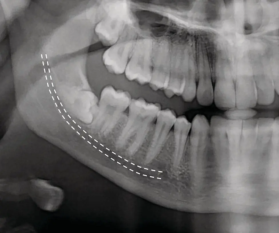 Figure 21 In the posterior region of the mandible the course of the inferior - фото 4