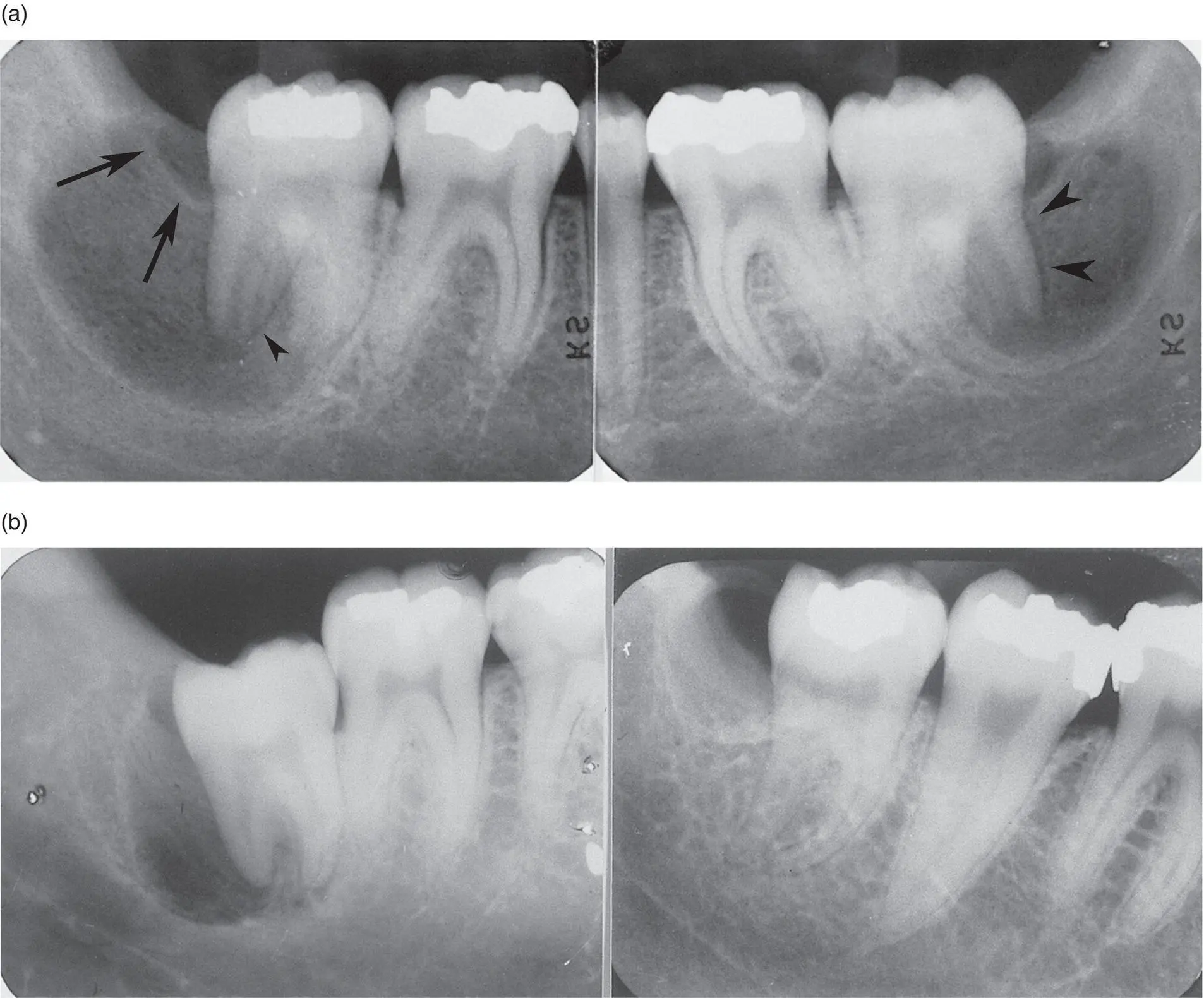 Figure 42 Paradental cysts a Bilateral cysts in a 13yearold associated - фото 26
