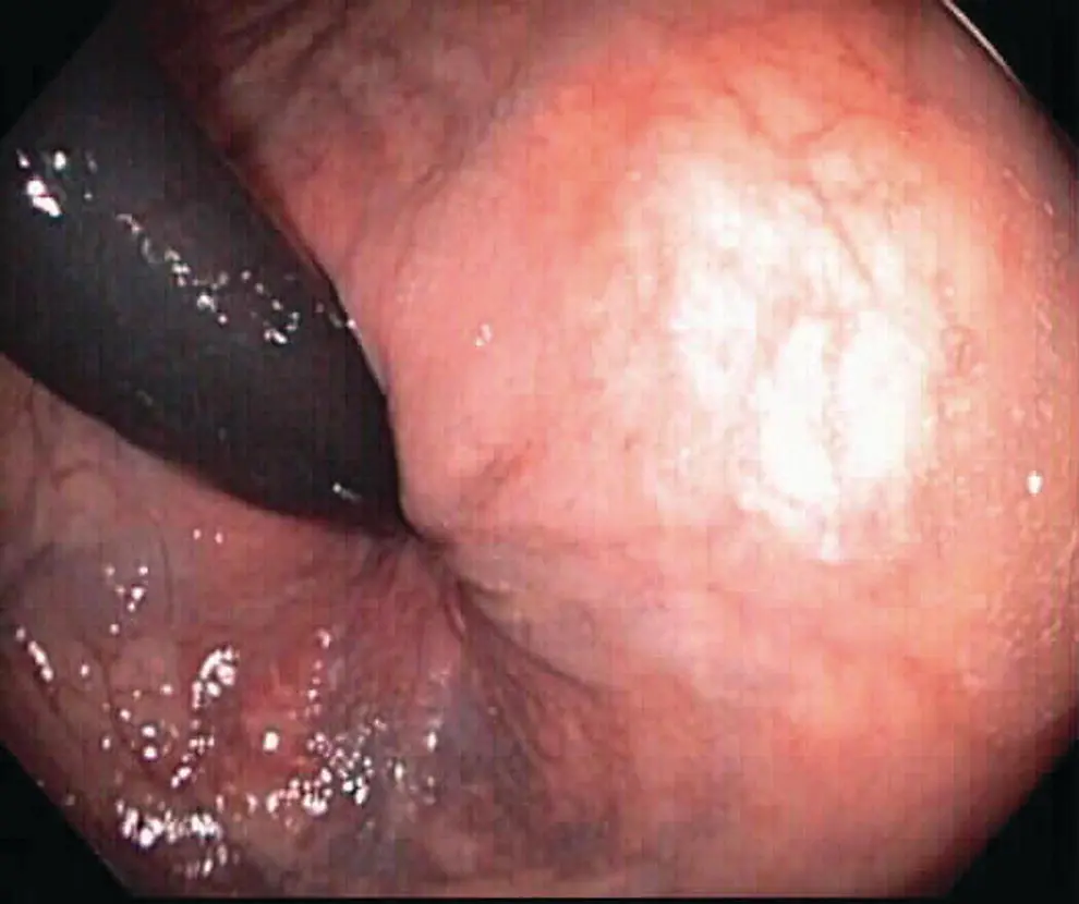 Figure 617 Retroflex views in rectum Retroflexion in the rectum allows for - фото 69