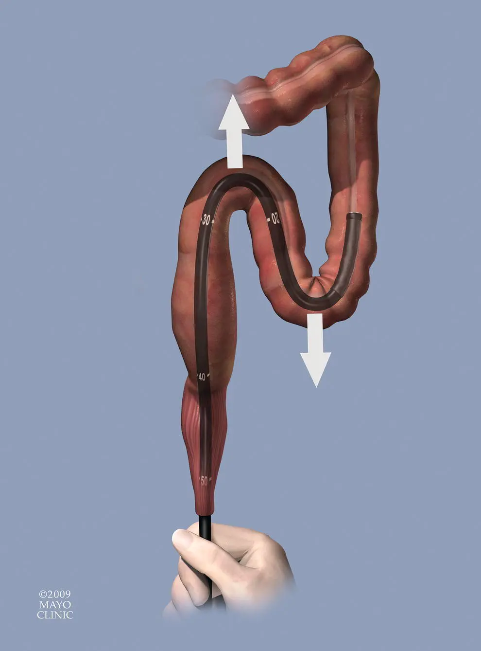 Figure 622 Sigmoid loop As the scope makes multiple turns in the sigmoid - фото 74