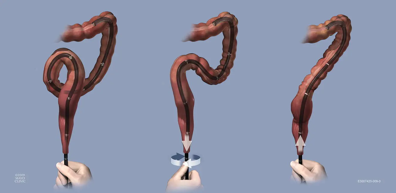 Figure 625 Reverse alphaloop A reverse alphaloop follows a similar - фото 80