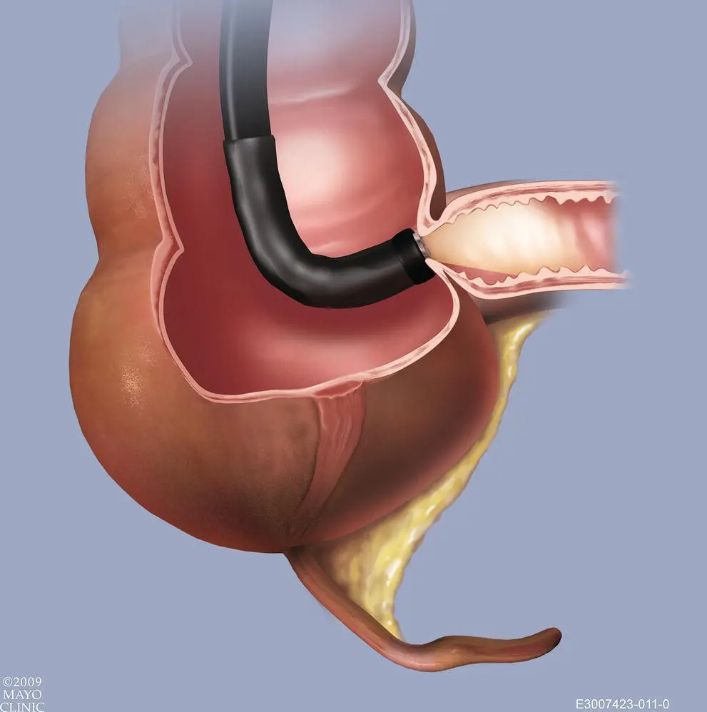 Figure 630 Incorrect TI maneuver Like the acute turns novice endoscopists - фото 88