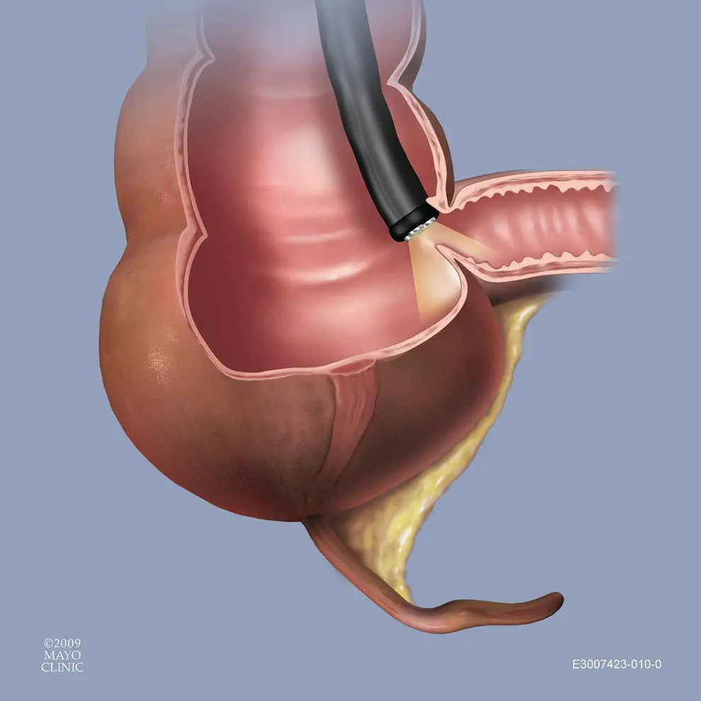Figure 629 Terminal ileum intubation To intubate the ileocecal valve the - фото 87