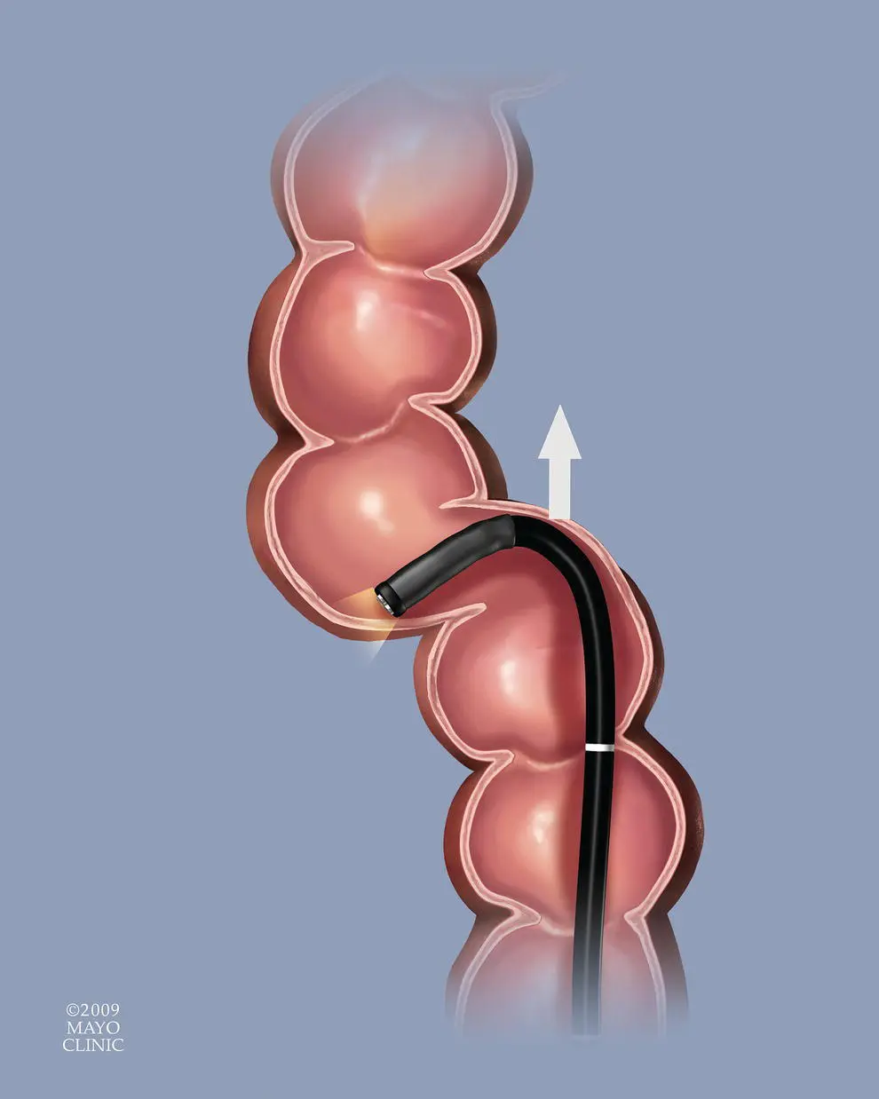 Figure 621 Force vector In this illustration the tip of the scope is - фото 73